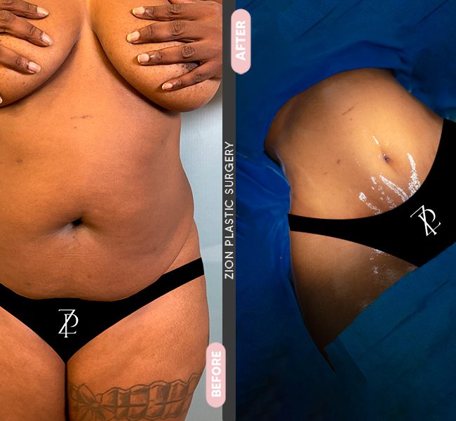 Tummy Tuck