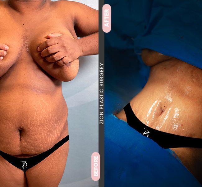 Tummy Tuck in Zion Miami