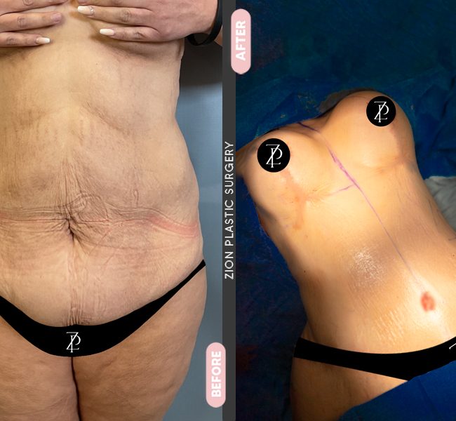 Tummy Tuck in Zion Miami