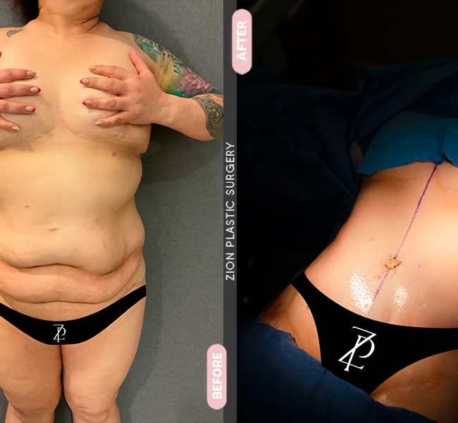 Tummy Tuck