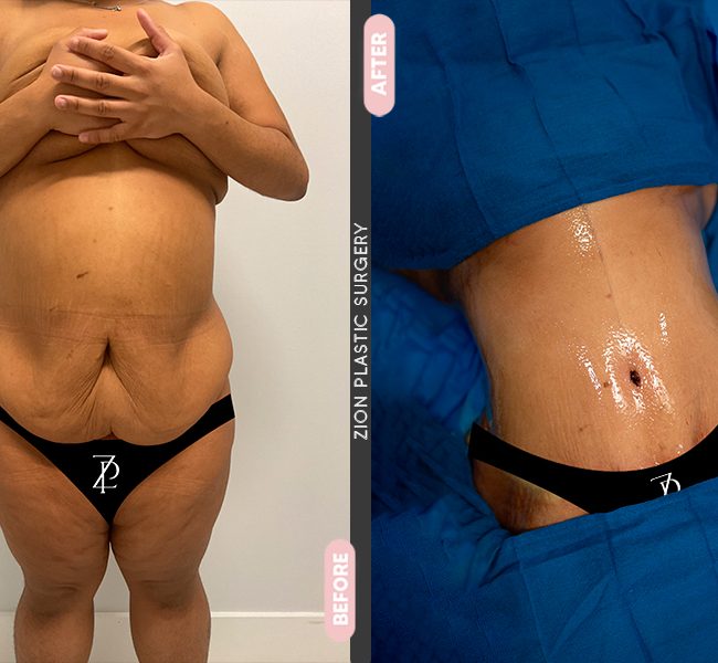 Tummy Tuck