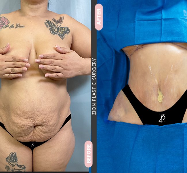 Tummy Tuck in Zion Miami