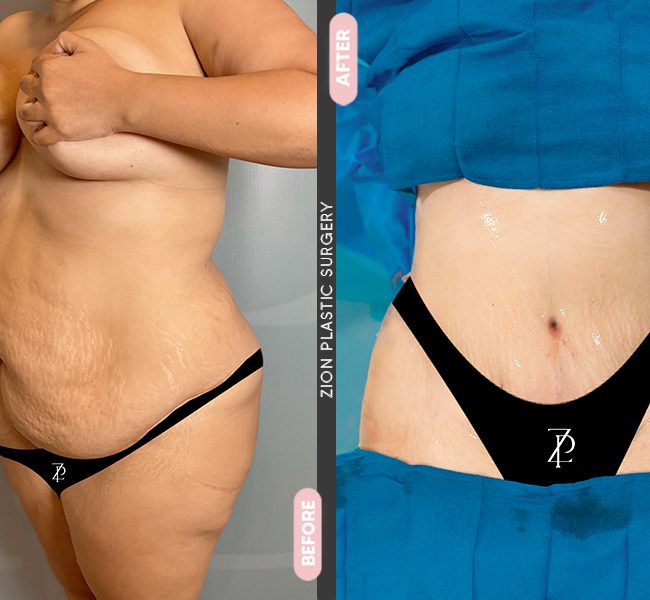 Tummy Tuck in Zion Miami