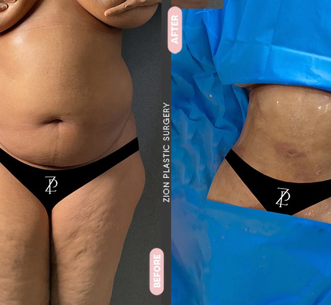 Tummy Tuck