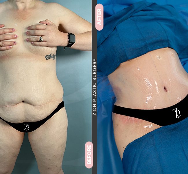 Tummy Tuck in Zion Miami