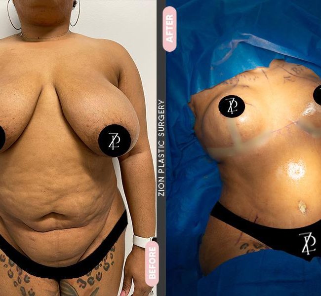 Patient before and after surgery