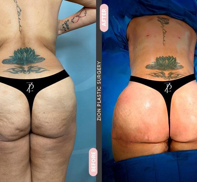 Patient before and after surgery