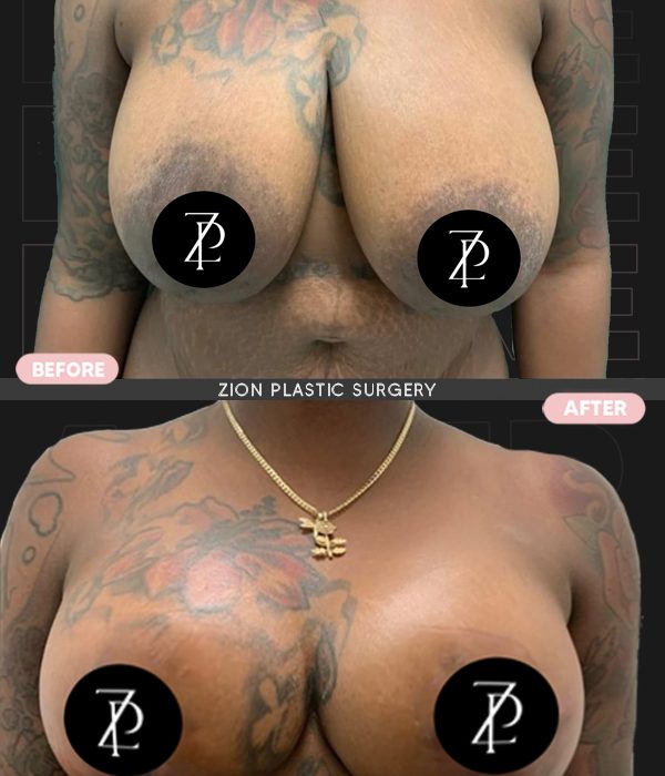 breastreduction3