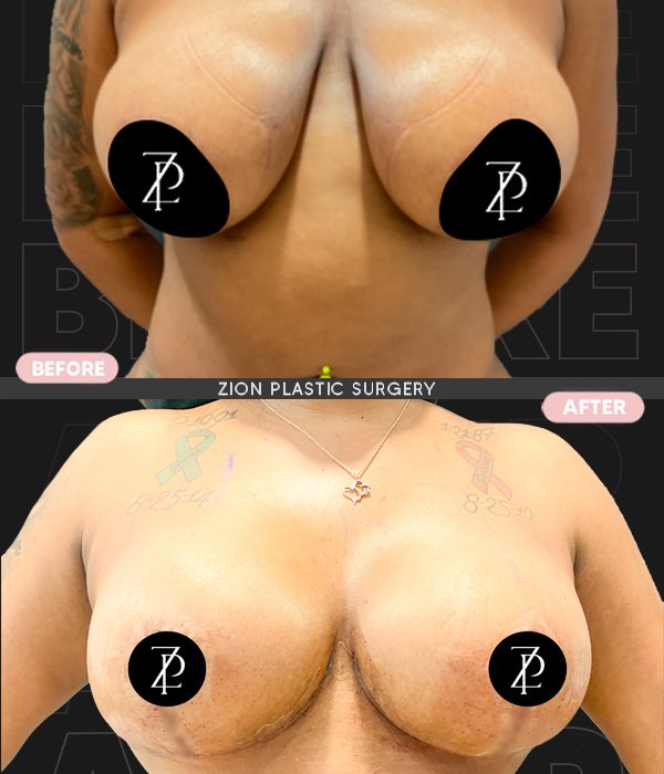 breastreduction4