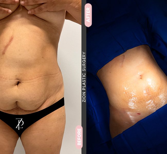 Tummy Tuck in Zion Miami