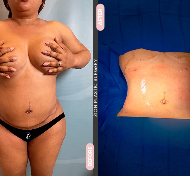 Tummy Tuck in Zion Plastic