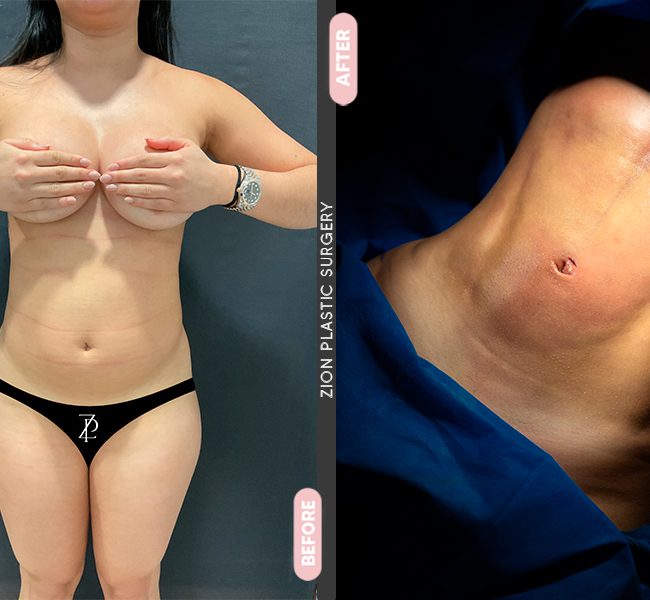 Tummy Tuck in Zion Plastic