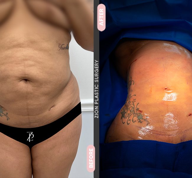 Tummy Tuck in Zion Plastic