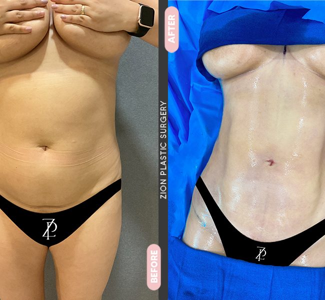 Tummy Tuck in Zion Plastic